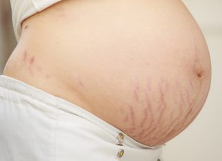 Pregnancy Stretch Marks Removal, Causes, Symptoms, and Treatment