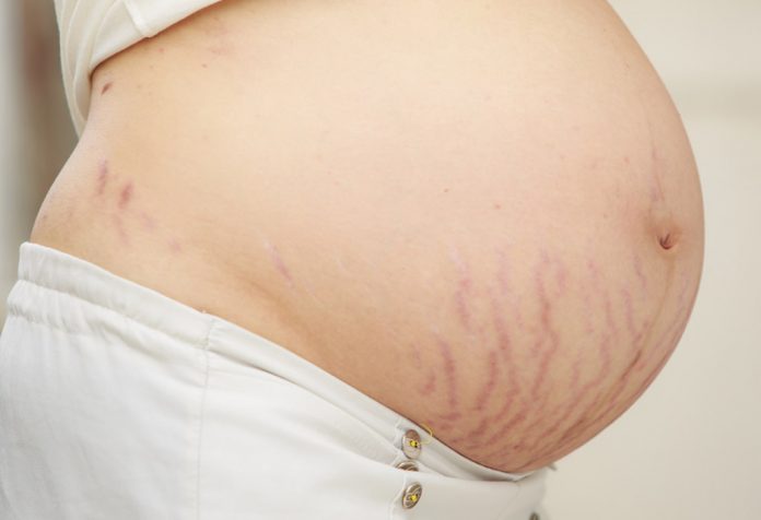 Pregnancy Stretch Marks Removal, Causes, Symptoms, and Treatment Pregnancy Stretch Marks Removal, Causes, Symptoms, and Treatment