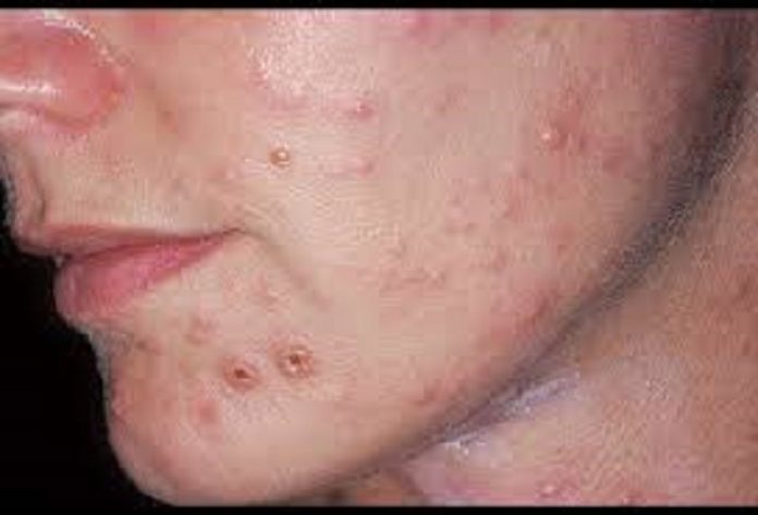 Skin fungal infections, Causes, Types, and Treatment