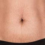 Stretch Marks Removal Question And Answer