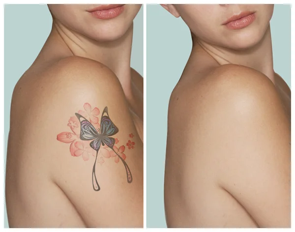PicoSure Tattoo Removal in Dubai - Laser Skin Care Clinic