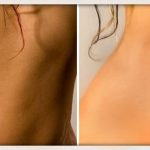 laser-stretch-mark-removal-specialist-midtown-nyc-1