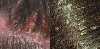 Oily Hair Treatment In Delhi, Procedure, Effects, Advantages