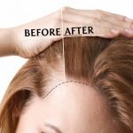 Hair Transplant Treatment Questions and Answers