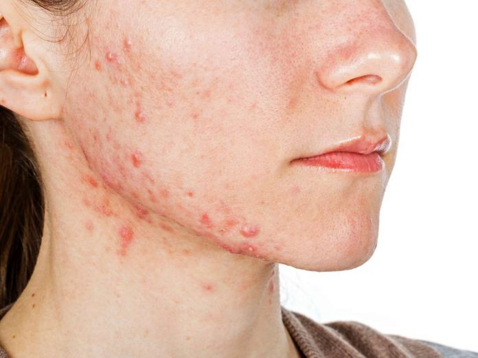 Acne Removal Question And Answer