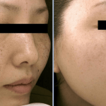 Dark Spot Removal