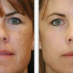 Melasma Treatment