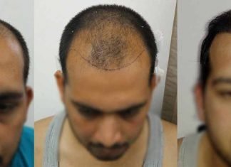 Direct Hair Transplant Procedure, Types, Risk, Advantages, and Cost