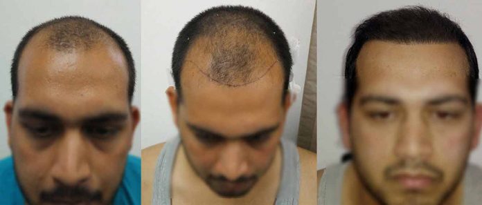 Direct Hair Transplant Procedure, Types, Risk, Advantages, and Cost