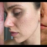 Acne scar removal in Delhi, Types of Laser Treatments, Benefits Acne scar removal in Delhi, Types of Laser Treatments, Benefits Acne scar removal in Delhi,