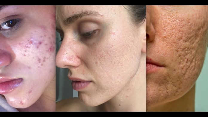 Acne scar removal in Delhi, Types of Laser Treatments, Benefits Acne scar removal in Delhi, Types of Laser Treatments, Benefits Acne scar removal in Delhi,