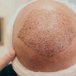 FUE Hair Transplant Procedure, Advantages, and Cost