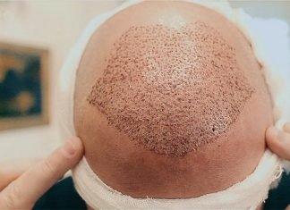 FUE Hair Transplant Procedure, Advantages, and Cost