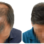 FUE Hair Transplant Procedure, Advantages, and Cost