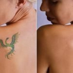 Tattoo Removal Recovery