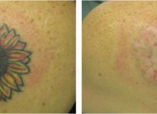 Tattoo Removal Recovery