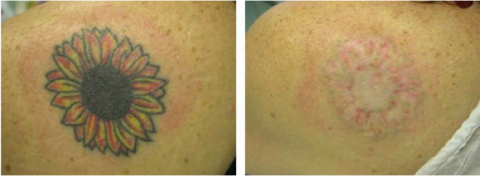 Tattoo Removal Recovery