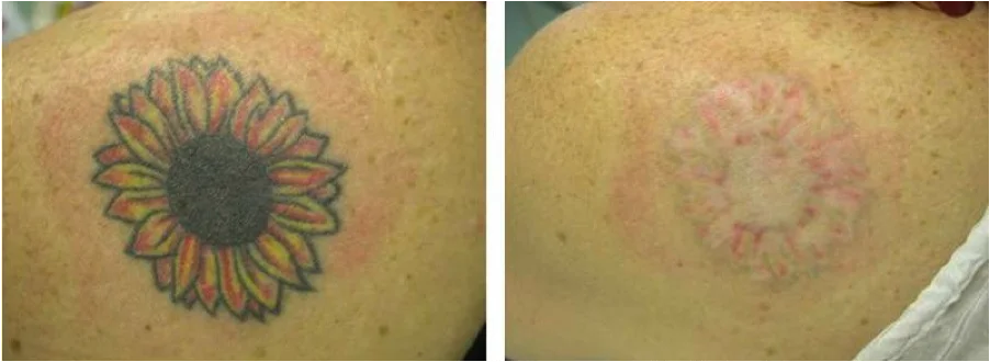 Is Tattoo Scarring Normal and Treatable? - Synergy Wellness