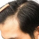 Hair transplantation, Causes of Hair Fall, Permanent Solution