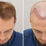 Hair Transplant Question