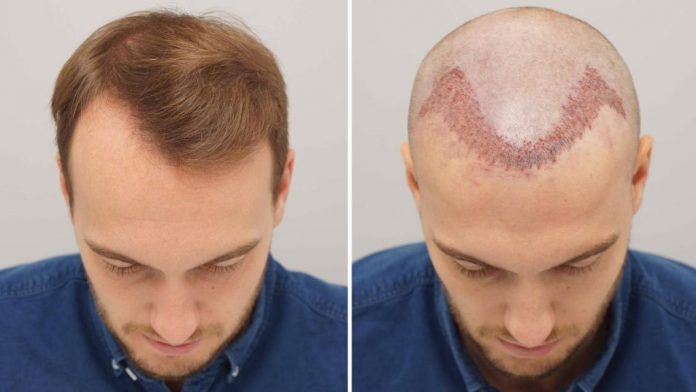 Hair Transplant Question