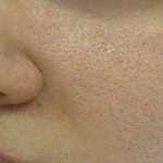 Large pores