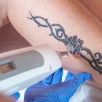 Laser Tattoo Removal, Get the Answer of most asked Questions