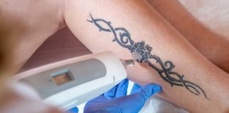 Laser Tattoo Removal, Get the Answer of most asked Questions