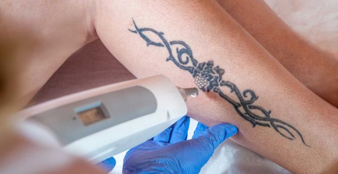 Laser Tattoo Removal, Get the Answer of most asked Questions