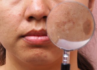 Melasma Treatment Question And Answer