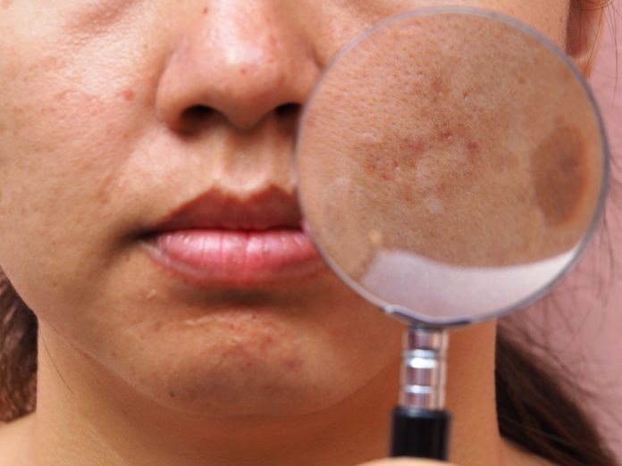 Melasma Treatment Question And Answer