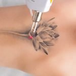 Laser Tattoo Removal, Get the Answer of most asked Questions