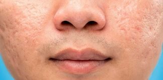 Large pores