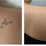 Laser Tattoo Removal, Get the Answer of most asked Questions