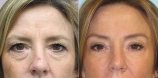 Brow Lift Treatment, Benefits, Candidates, And Procedure