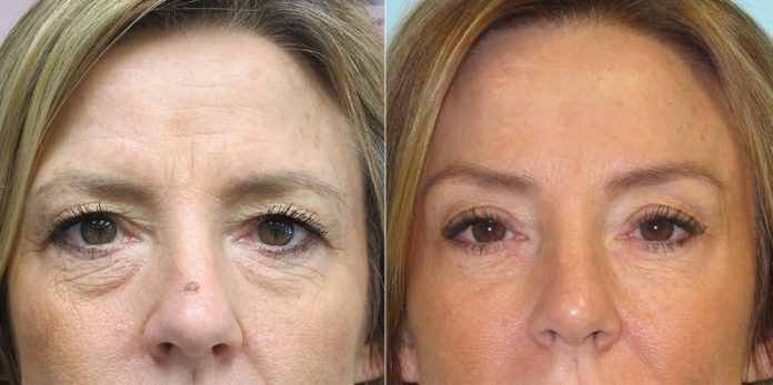 Brow Lift Treatment, Benefits, Candidates, And Procedure Brow Lift Treatment, Benefits, Candidates, And Procedure