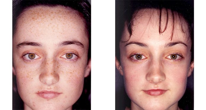 Chemical Peel Treatment And Its Types Chemical Peel Treatment And Its Types