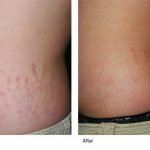 Laser Stretch Marks Removal Best Treatment
