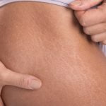 Laser Stretch Marks Removal Best Treatment
