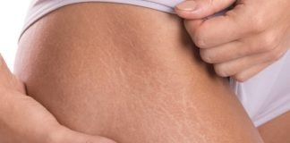 Laser Stretch Marks Removal Best Treatment