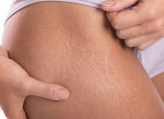 Laser Stretch Marks Removal Best Treatment