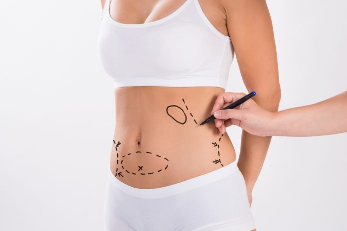 Liposuction Treatment A Instant Weight Loss Procedure Liposuction Treatment A Instant Weight Loss Procedure