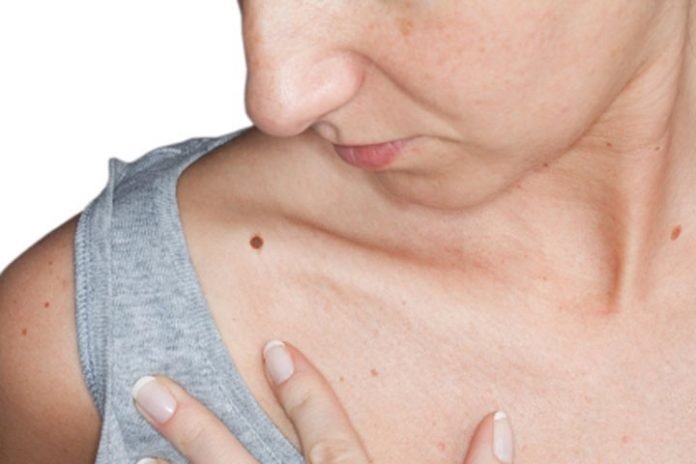 Moles Removal Causes And Best Treatment Options