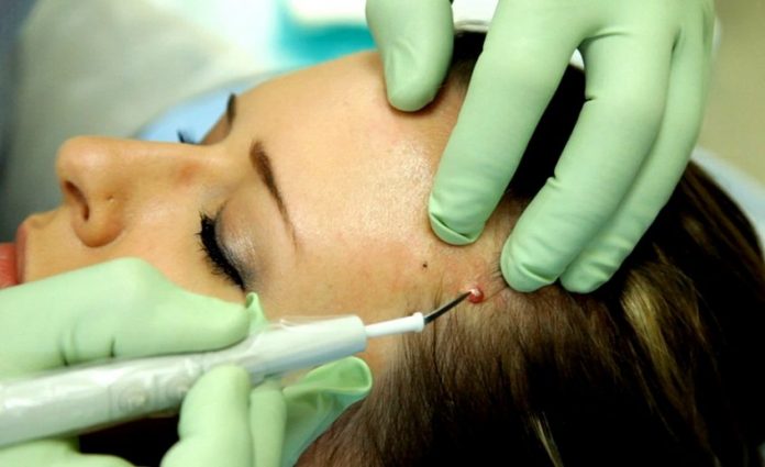 Radiofrequency For Wart Removal, Procedure, Guidelines, and Cost Radiofrequency For Wart Removal, Procedure, Guidelines, and Cost