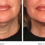 Ultherapy Anti-Aging Treatment To Lift Your Chin, Brows And Neck