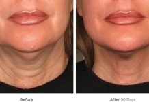 Ultherapy Anti-Aging Treatment To Lift Your Chin, Brows And Neck