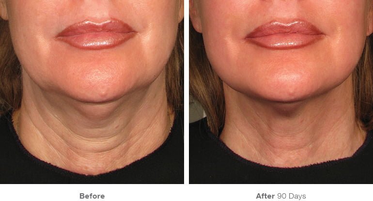 Ultherapy Anti Aging Treatment To Lift Your Chin Brows And Neck