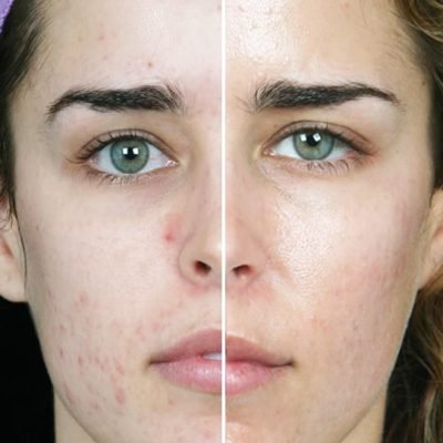 The Magical Hydra Facial Will Remove All Your Skin Disorder