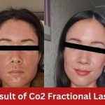 co3 fractional laser at adorable clinic
