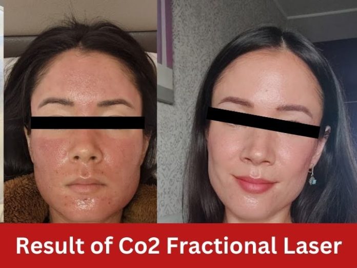 co3 fractional laser at adorable clinic